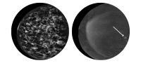 2 mammogram images
